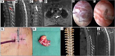 Complete removal of intraspinal extradural mass with unilateral biportal endoscopy